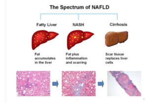 Alternatieven voor leverbiopsie bij NASH